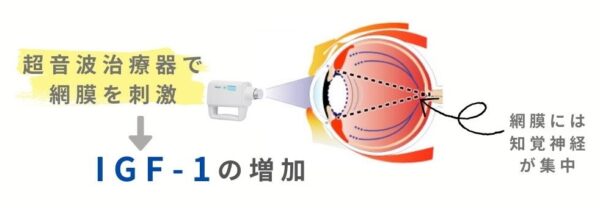 超音波治療器でIGF-1が増加